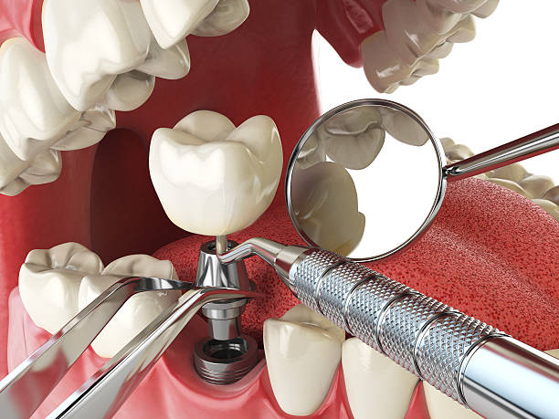 Best Dentist for Tooth Abscess  in Svis, IL